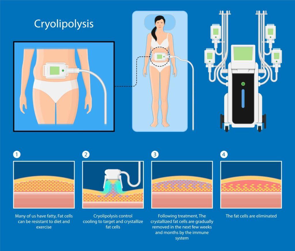 Infografik zeigt den Prozess der Kryolipolyse: Anwendung am Bauch, gezielte Kuehlung, Kristallisation von Fettzellen und deren Abbau durch das Immunsystem